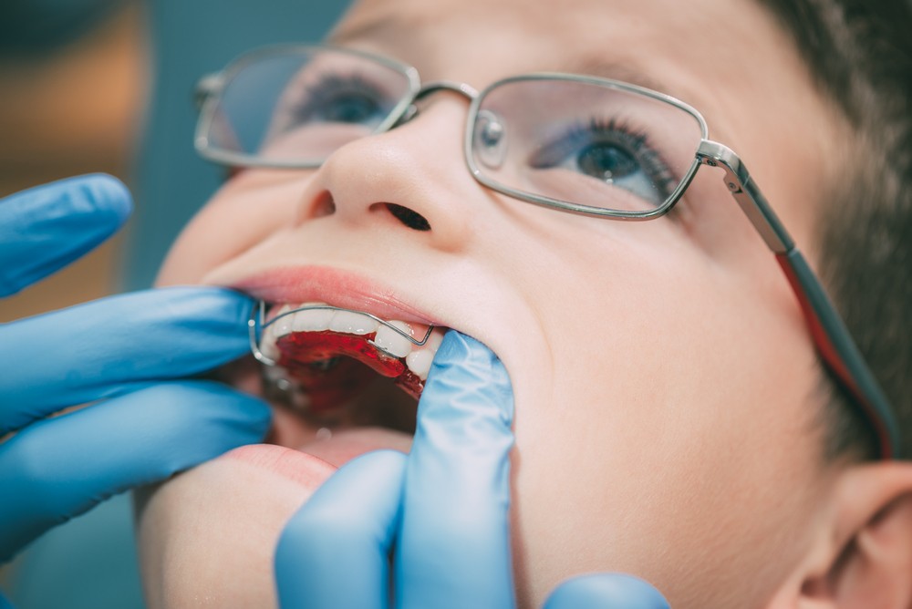 ortodontie bucuresti, aparat dentar metalic bucuresti, aparat dentar