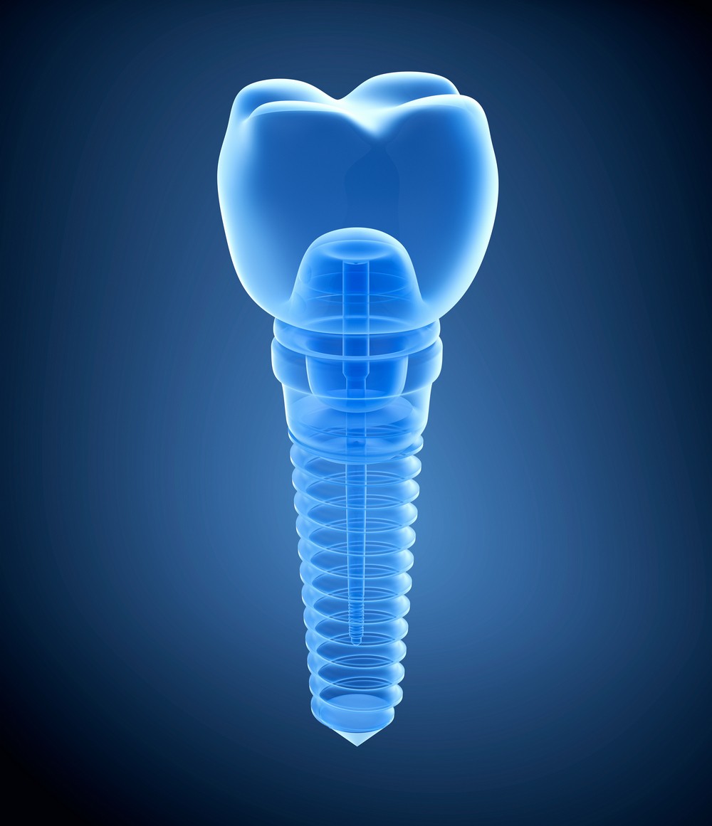implant dentar bucuresti, implantologie bucuresti, denta g international bucuresti