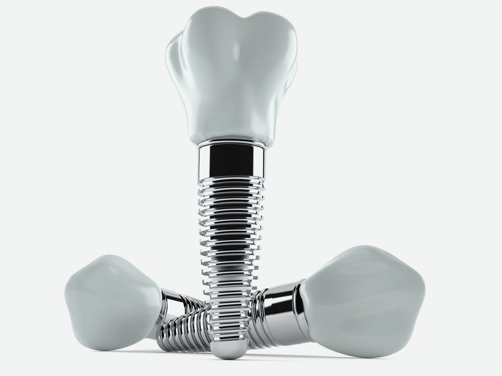 implant dentar bucuresti, implantologie bucuresti, denta g international bucuresti