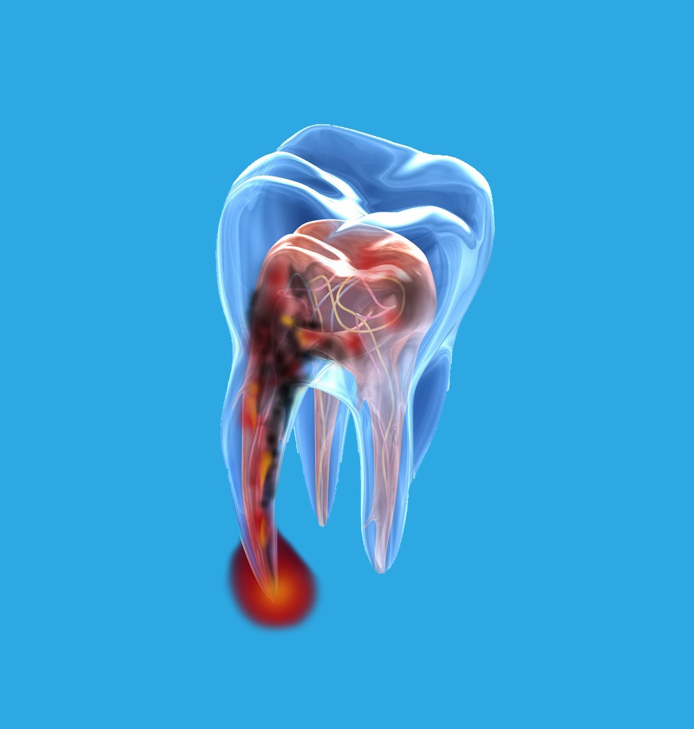 tratament endodontic bucuresti, endodontie bucuresti, tratament de canal bucuresti, denta g internat