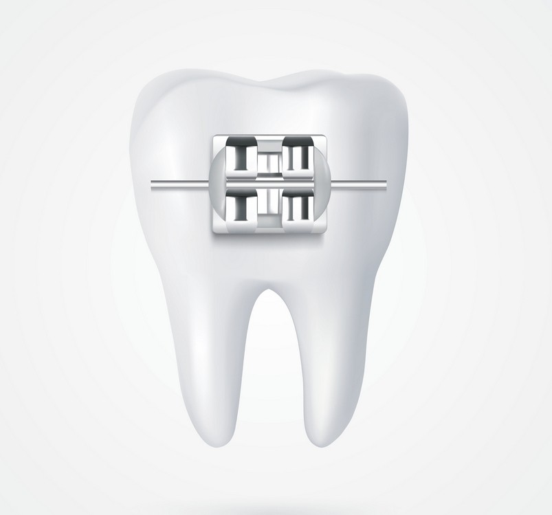 ortodontie bucuresti, aparat dentar metalic bucuresti, aparat dentar ceramic bucuresti, aparat safir